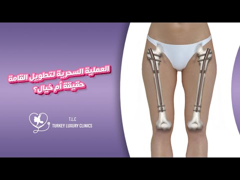 جراحة تطويل القامة الحلول الجراحية لزيادة الطول واستعادة التناسق عيادات تركيا لاكشري كلنيك 