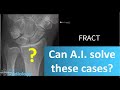 Artificial Intelligence vs Radiologist - Fracture Detection