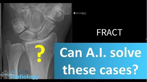 Artificial Intelligence vs Radiologist - Fracture Detection