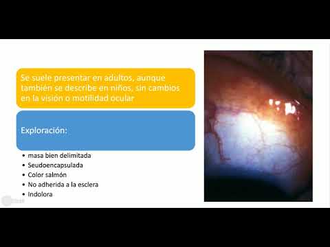 Vídeo: Hiperplasia Linfoide Reactiva Benigna Bilateral De La Conjuntiva: Un Caso Tratado Con Doxiciclina Oral Y Revisión De La Literatura