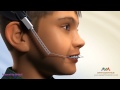 Orthodontic Treatment For Overjet Overbite Headgear Appliance