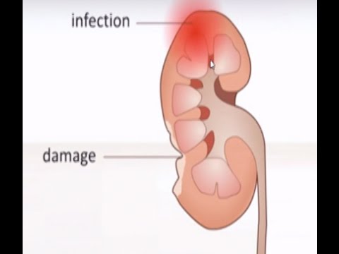 Видео: Бактериална инфекция (пиелонефрит) на бъбреците при кучета