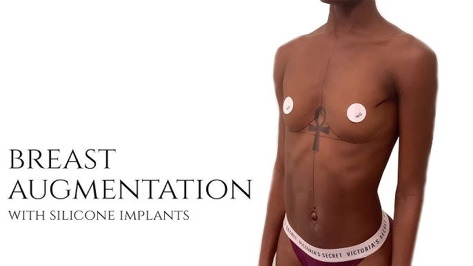 Breast Augmentation Silicone Implants on Athletic African American Body