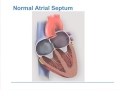 Patent Foramen Ovale (PFO) and Migraine