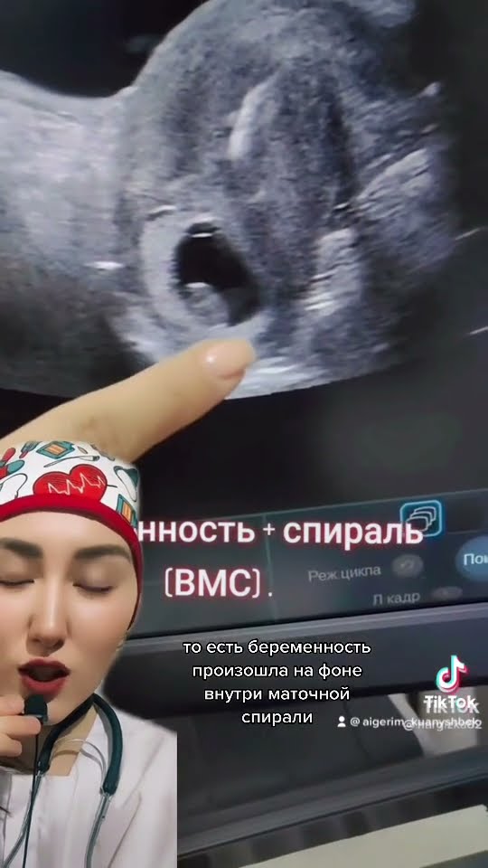 Можно ли забеременеть через ВМС?