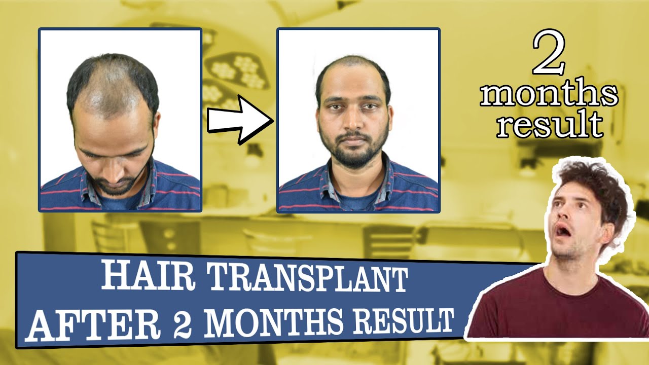 Amazing Result of Hair Transplant after 2 months Hair Transplant in