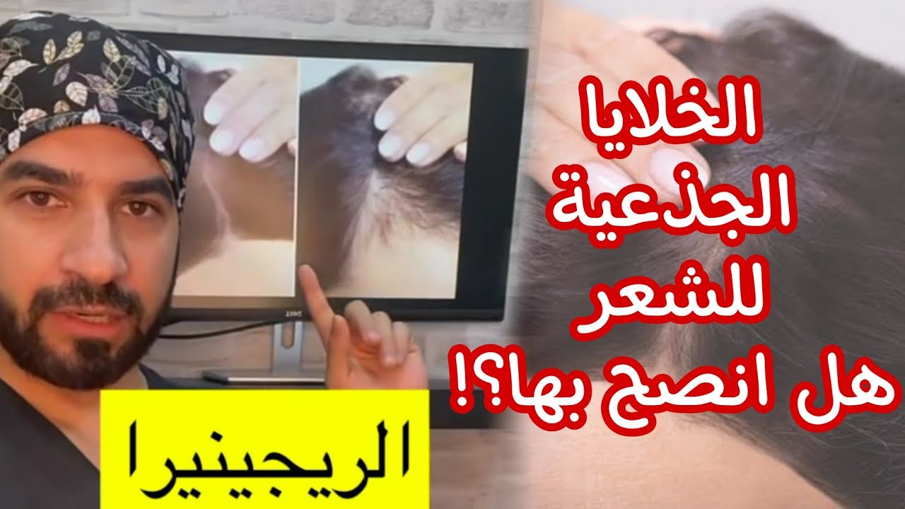 الخلايا الجذعية للشعر - دكتور طلال المحيسن