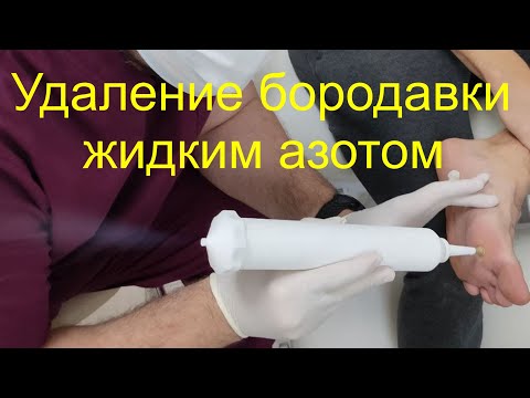 Удаление бородавки часть1. Вторая часть в следующем видео.