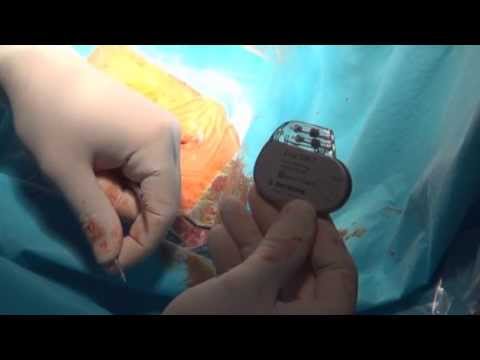 Video: Implantace Křeče: Načasování, Umístění A Další