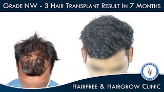 Best Hair Transplant Result in 7 Months || NW-3 Grade || Hairfree & Hairgrow Clinic Bhopal