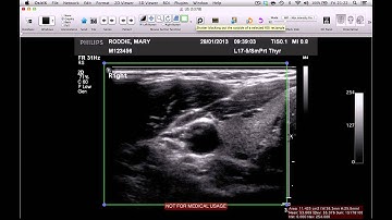 How to remove patient name from medical images on OsiriX