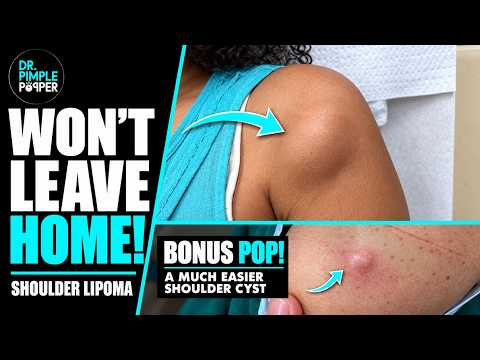 How To Handle a Lipoma That Didn't Want to Leave | Dr. Pimple Popper | PLUS a bonus shoulder pop!