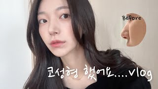 [VLOG] 코수술 당일에서 6주차까지 | 메부리, 무보형물, 복코교정, 기능코 | 붓기빠지는 과정