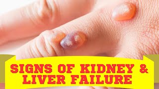 10 Warning Signs of Liver or Kidney Failure