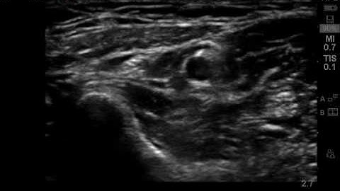 Ultrasound guided superficial radial nerve block in the forearm.