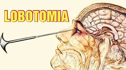 O que a lobotomia faz com a pessoa?