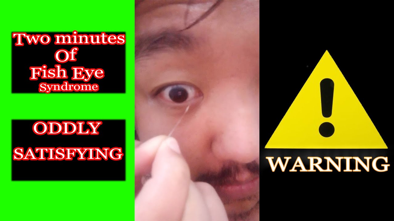 Mucus eye syndrome (conjunctivitis) Very Itchy Satisfying compilation
