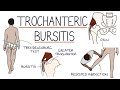 Understanding Trochanteric Bursitis