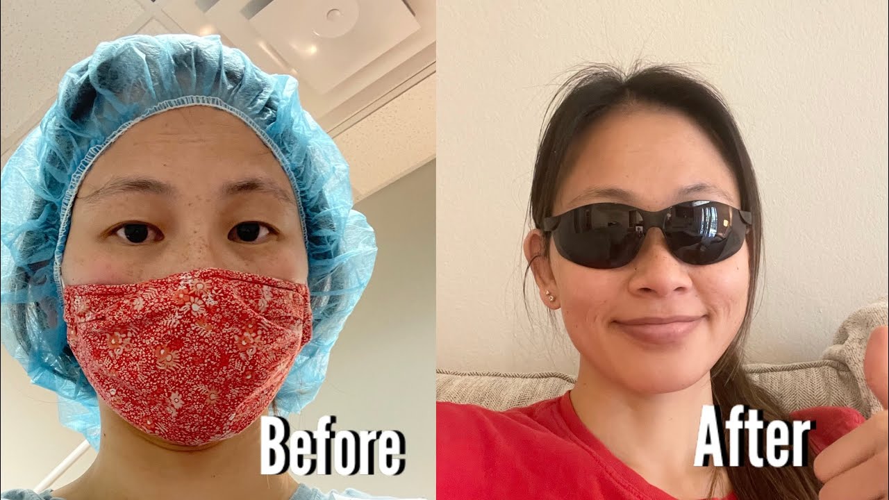 My LASIK eye surgery experience!
