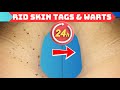 How to RID SKIN TAG and WARTS Within 24 HOURS