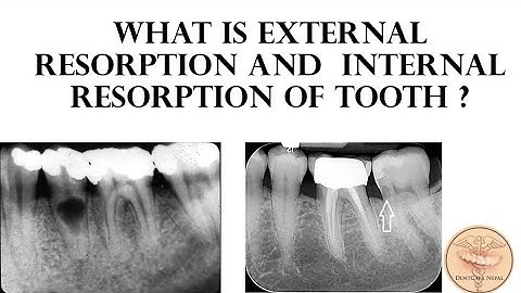External Resorption and Internal Resorption of Tooth