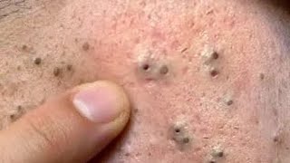 sac be spa blackhead elderly men face  |sac be spa men face blackhead new 2026 | StepbyStep new #555