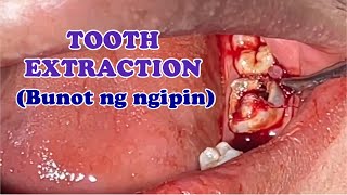 TOOTH EXTRACTION: Pulp Polyp 🦷 screenshot 2