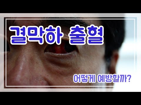 눈핏줄이 터졌다구요?? 걱정마세요!! 병원장tv가 알려드리겠습니다~~