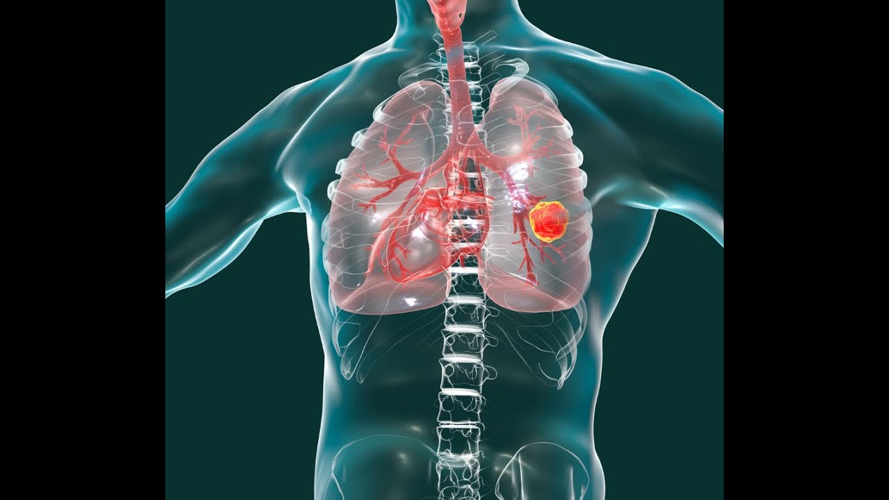 Overview of Management of Non Metastatic Non Small Cell Lung Cancer ...