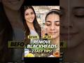 Remove blackheads , 2 easy tips ☺️☺️💕💕