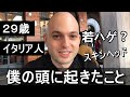 【若ハゲ】29歳イタリア人の毛根との戦い