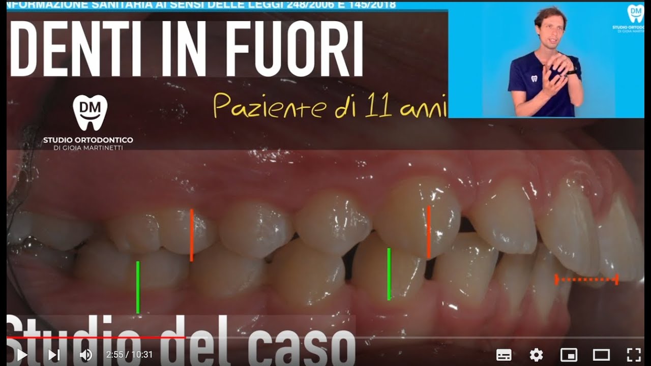 Denti in fuori seconda classe-  Ruolo apparecchio, degli allineatori e delle mascherine trasparenti!