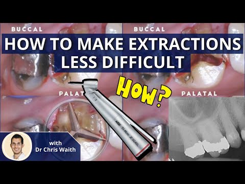 Make Extractions Less Difficult: Sectioning and Elevating Teeth PDP085