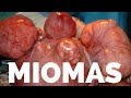 MIOMAS UTERINO