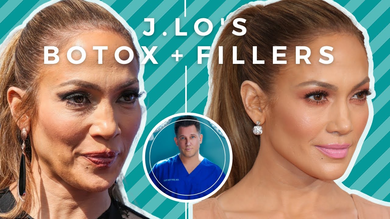 Jennifer Lopez'S Botox And Filler Plastic Surgery: A Plastic Surgeon Weighs  In - Youtube