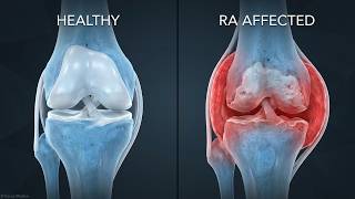 Rheumatoid Arthritis