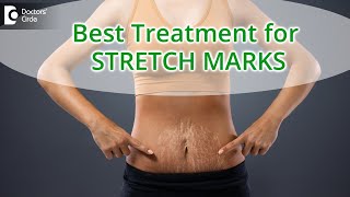 10 Ways to Get Rid of Stretch Marks | Stretch Marks Removal - Dr  Divya Sharma | Doctors' Circle