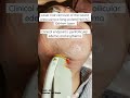Laser hair removal of the beard area shorts