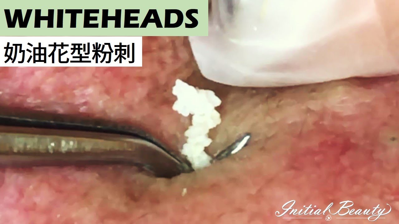 Whiteheads extracting with pro tool
