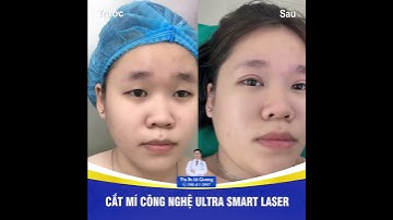 Cắt mí bằng Laser, không đau, không sưng | Bác sĩ Lê Quang