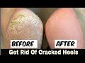 Home Remedy to Remove Cracked Heels Fast 