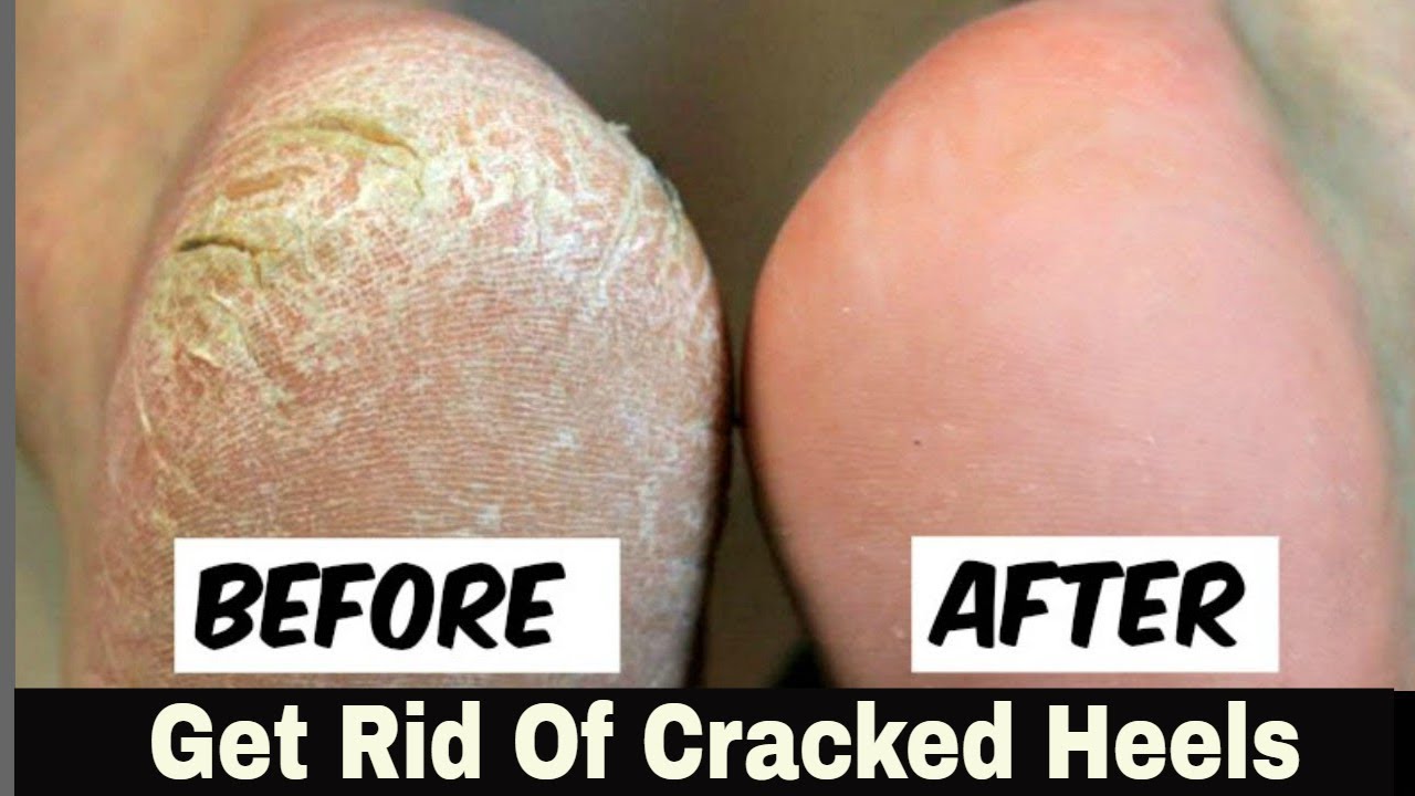 5 Easy Ways To Treat Cracked Heels – SkinKraft