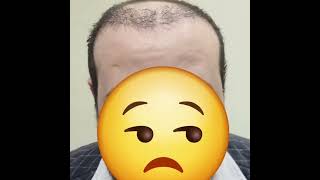 إصلاح زراعه شعر فاشله : شوف عملنا ايه