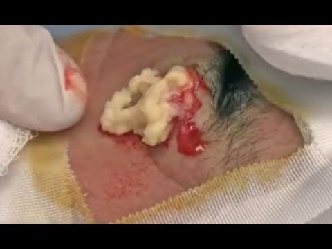 Best Cysts Ever! Pimple Pops, Cyst Removal and Cystic Acne!