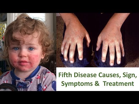 What is Fifth Disease ? Fifth Disease Causes, Sign Symptoms, Treatment