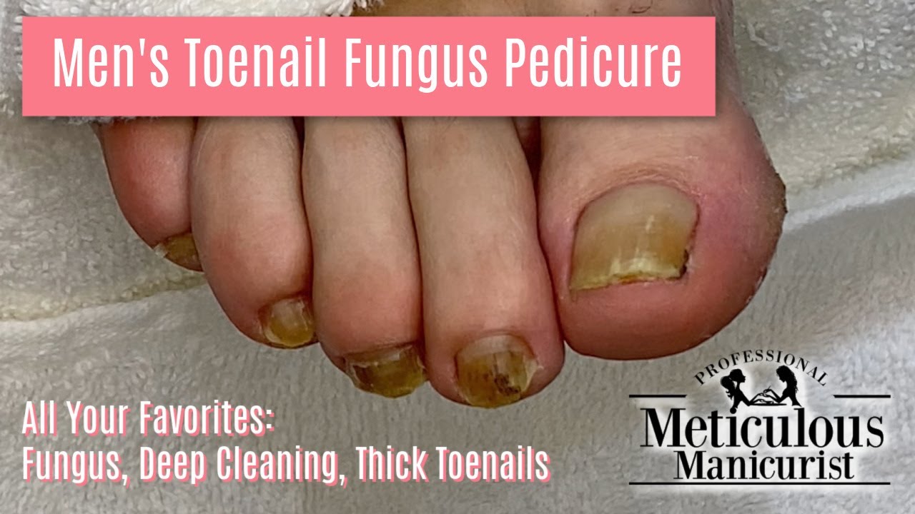 👣 Pedicure Transformation with All Your Favorites - Fungus, Deep Cleaning, Thick  Toenails👣 