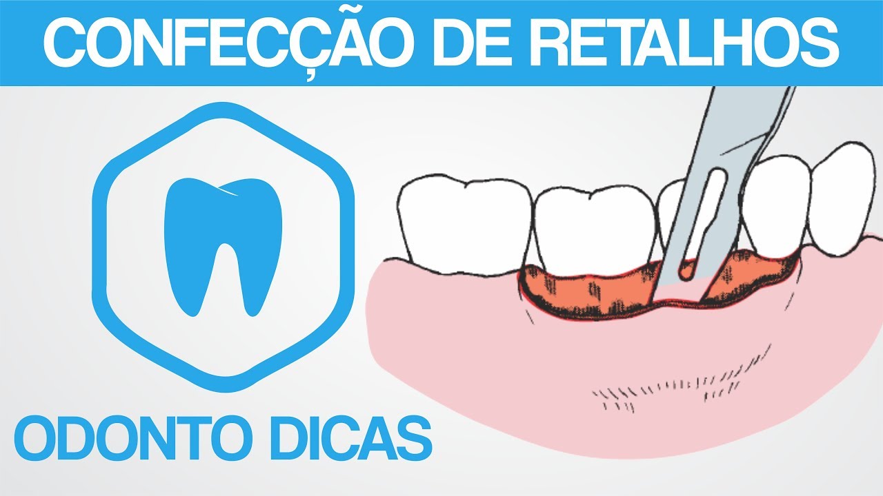 Retalho Romboidal Tipos De Retalhos Odontologia - RETOEDU