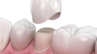 تركيبات الأسنان - Fixed prosthodontics