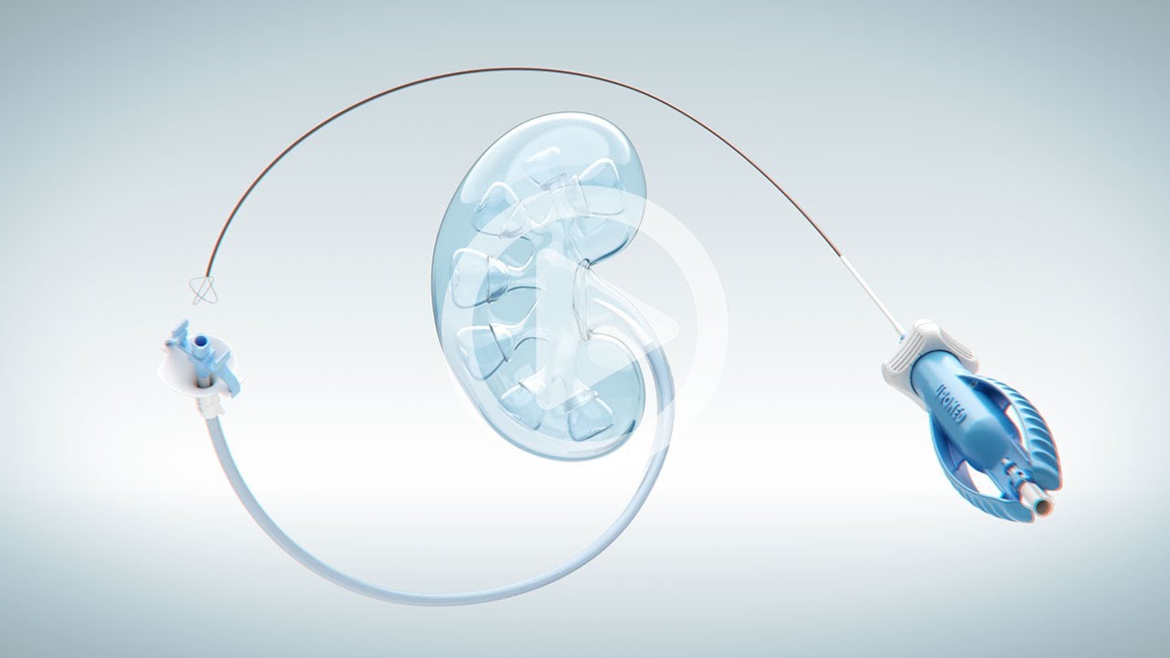 Stone Retrieval - UROMED UROporta Ureteral Access Sheath and STONIZER ROTAR Stone Retrieval Basket