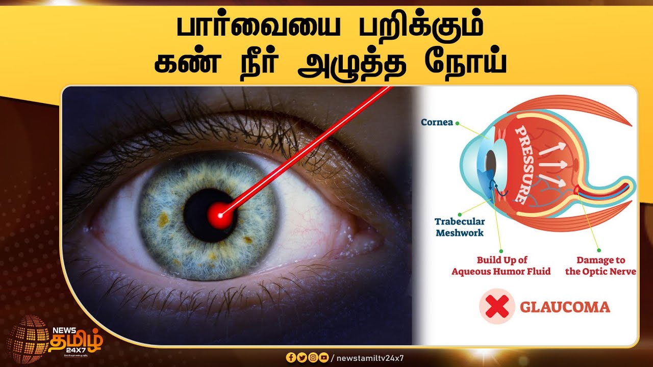 What is glaucoma disease |கண் நீர் அழுத்த நோய் என்றால் என்ன?|பார்வையை பறிக்கும் கண் நீர் அழுத்த நோய்
